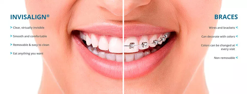 Close-up of smiling mouth comparing Invisalign clear aligners and traditional braces treatment options.