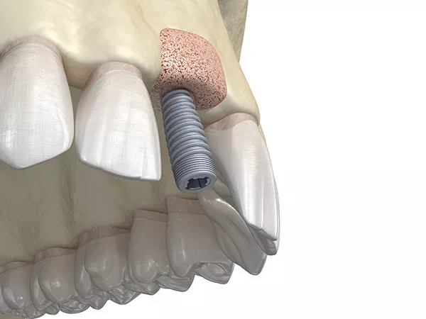 Dental implant model showing screw placement in jawbone during surgical procedure demonstration.