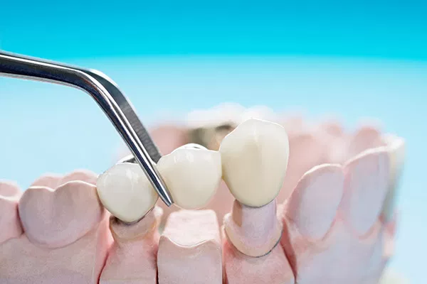 Dental implant procedure showing tooth replacement in mouth model with dental tools and prosthetic teeth.