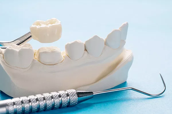 Dental model showing tooth implants and crowns with professional instruments on blue surface.