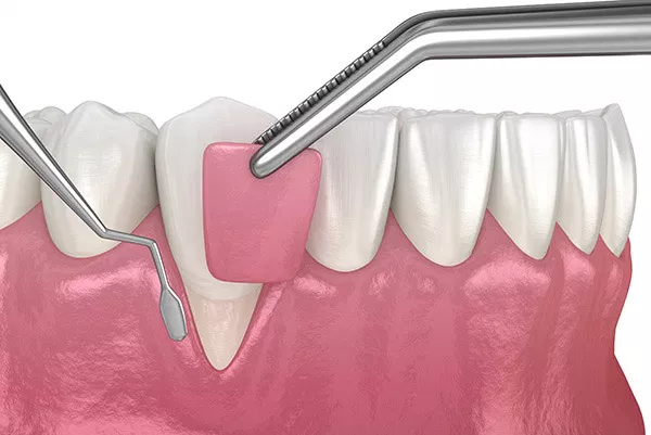 Dental tools demonstrating gum grafting procedure on tooth and gum model.