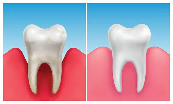 Two tooth diagrams comparing healthy tooth structure with gum tissue against blue sky background.