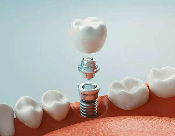 Dental implant diagram showing tooth replacement components stacked above gum tissue model.