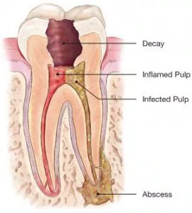 Dental cross-section showing tooth decay progression from decay to inflamed pulp, infected pulp, and abscess formation.