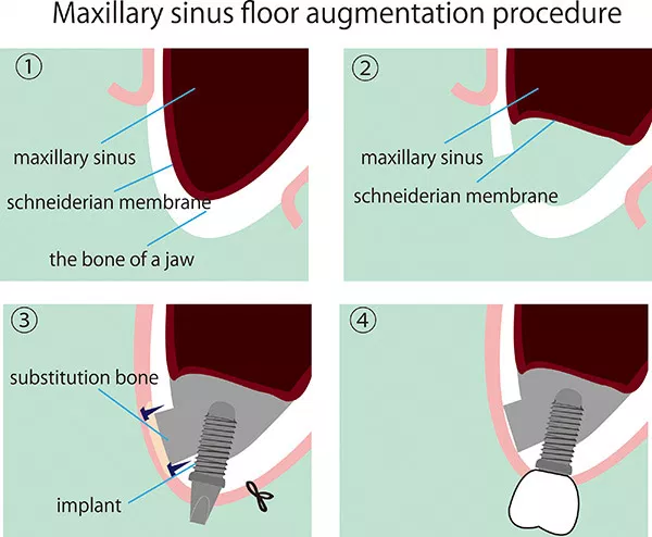 Four-step diagram illustrating maxillary sinus floor augmentation dental implant procedure with bone grafting.