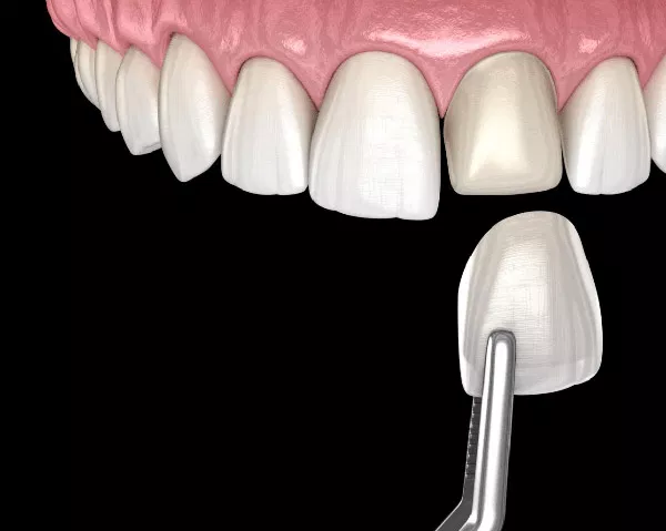 Digital illustration of dental crown placement on lower tooth model against black background.