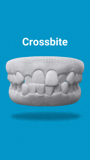 Crossbite dental model showing misaligned upper and lower teeth on blue background