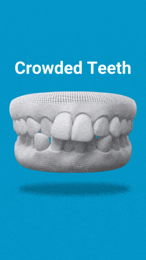 Dental model showing crowded teeth condition against blue background with label.