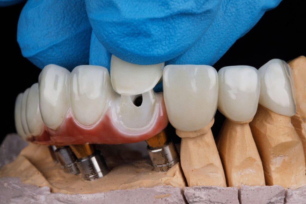 Dental Veneers in Rockville Centre NY