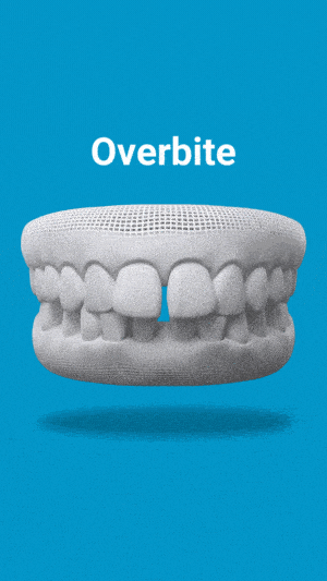 Dental model showing overbite condition with upper teeth protruding over lower teeth against blue background.