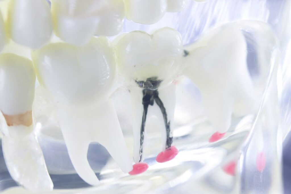 Root Canal Dentist in Rockville Centre, NY