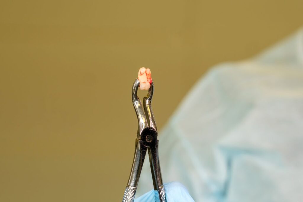 Teeth Extractions in Rockville Centre NY