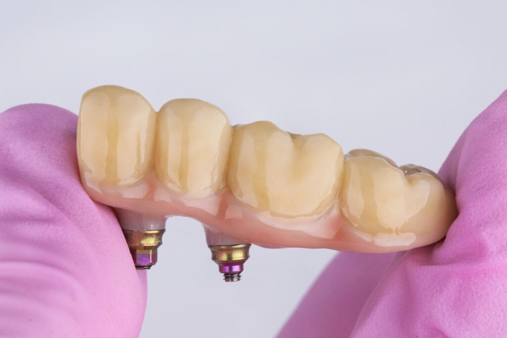 Dental Bridges in Rockville Centre
