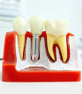 Dental implant model showing tooth structure, implant fixture, and crown on red anatomical base.