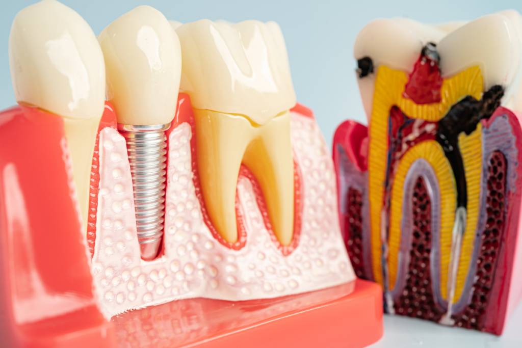 dental implants in Rockville Centre