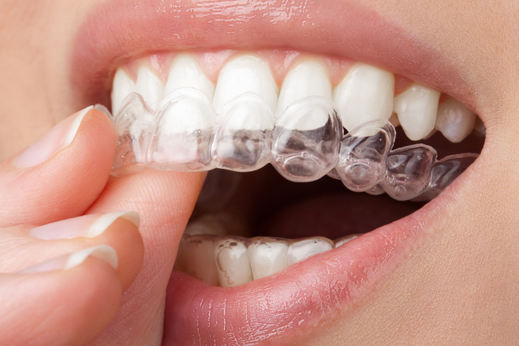 invisalign in Rockville Centre