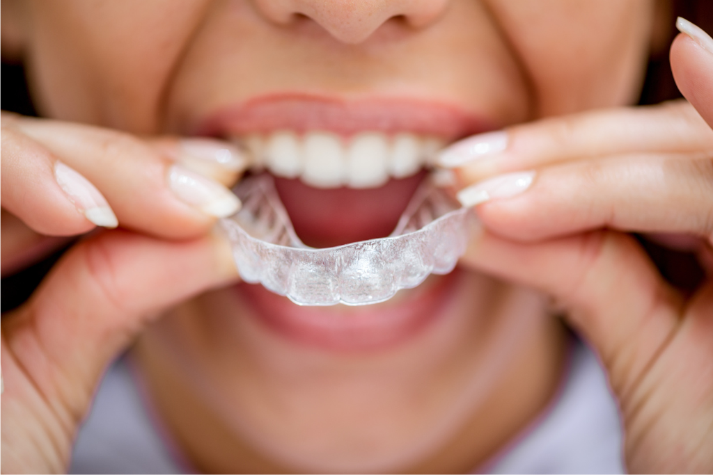 Featured image for “Can Invisalign Prevent Future Dental Problems?”