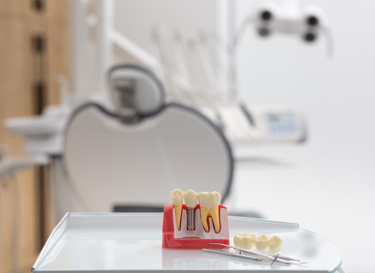 Featured image for “After Bone Grafting: Your Complete Recovery Guide to Implant Success”